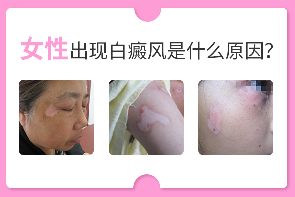 誘發(fā)女性長白癜風(fēng)的原因有哪些呢？