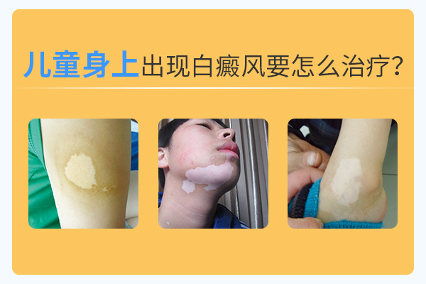 兒童治療白癜風過程中要避開什么呢？
