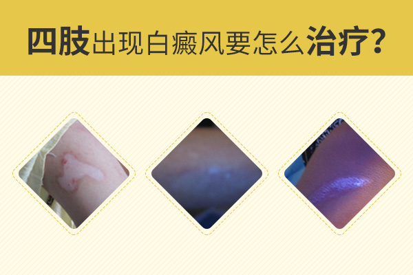 為什么手腳上的白癜風(fēng)會比較難治呢？