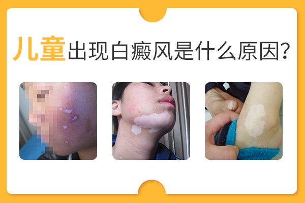 合肥兒童會(huì)因?yàn)槭裁丛蚨忌习遵帮L(fēng)呢？